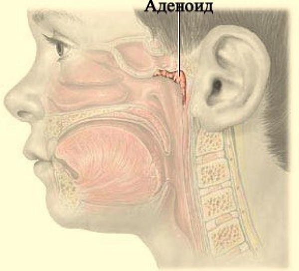 Белые сопли. Гиперпластический ринит аденоиды.